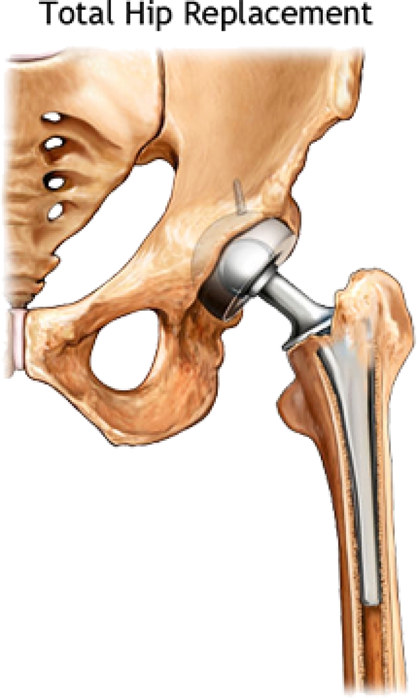 How long will my hip replacement last? Dr. Shahin S. Rad